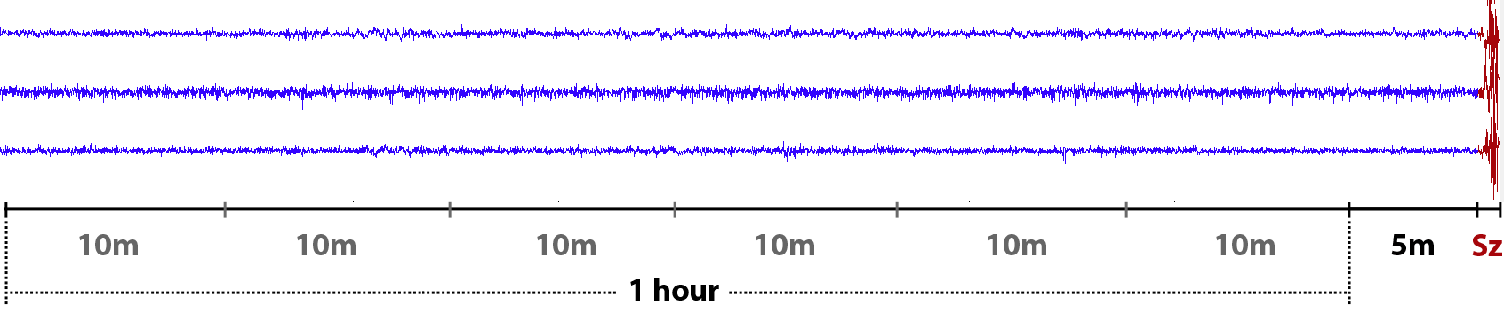An example of a preictal EEG record (3 channels out of 16, picture from Kaggle) 